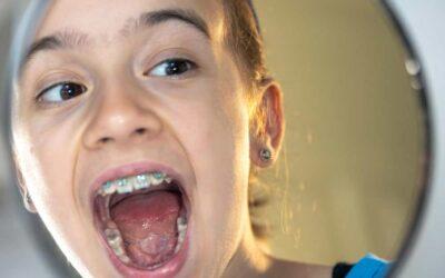 ¡Cómo limpiar los brackets?