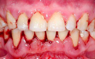 Cómo tratar y prevenir la gingivitis