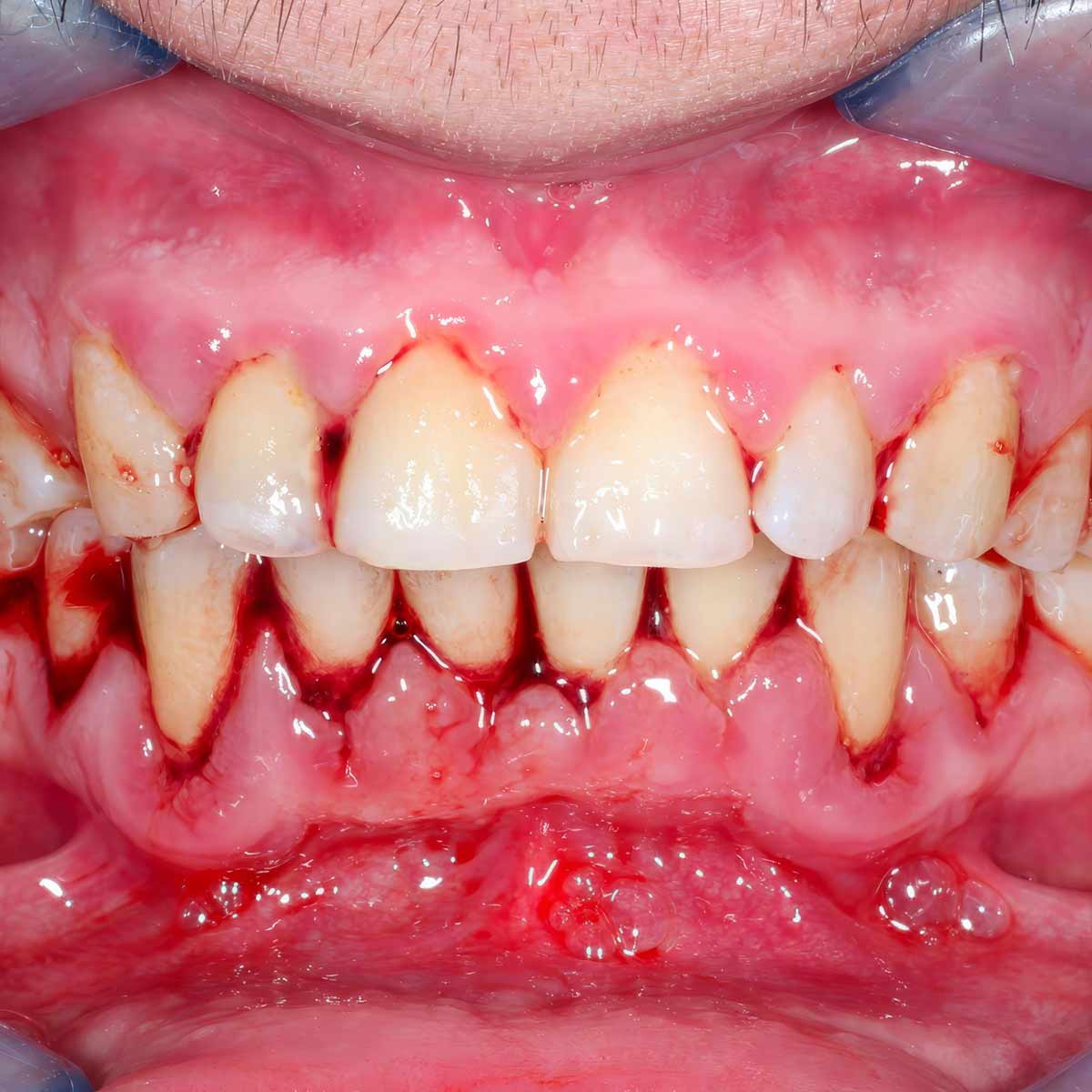 tratar-prevenir-gingivitis
