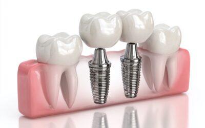 Implantes dentales en Vitoria: recupera tu sonrisa con garantías